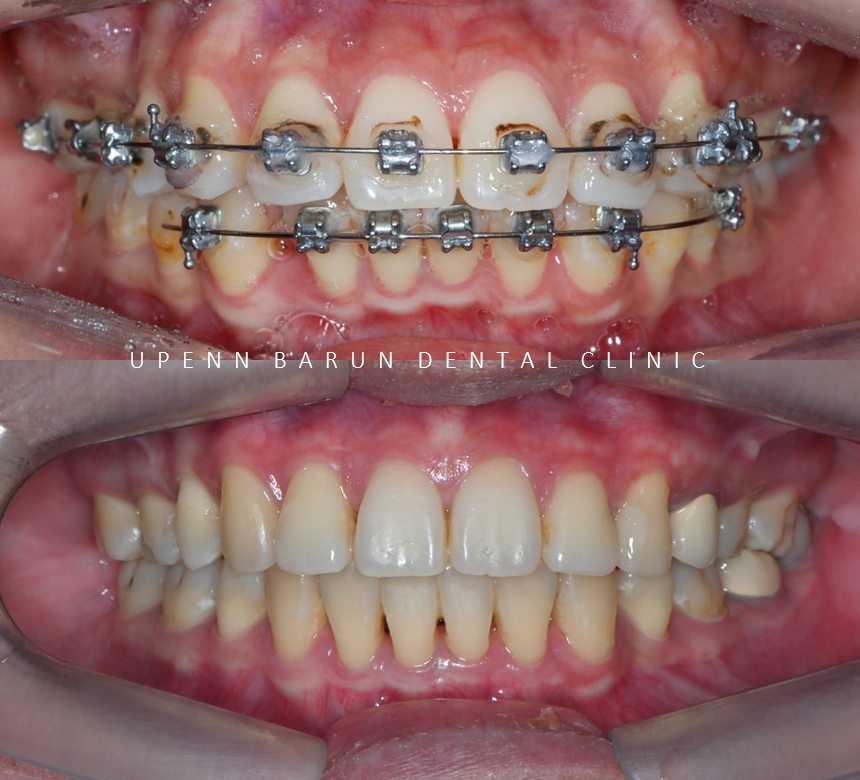 수술이 필요없는 잠실돌출입교정 잠실교정치과 입술이 잘 안다물어져 고민이라면? (돌출입전후 잠실새내교정치과 잠실발치교정 발치교정전후사진) 관련 이미지 10