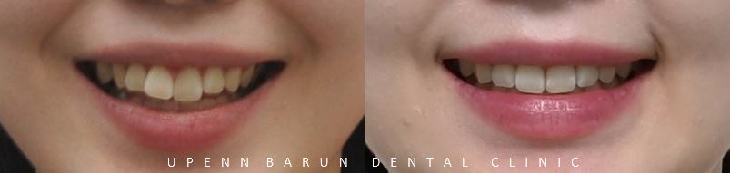 앞니부분교정 인비절라인라이트로 해결하기 (잠실인비절라인치과 송파인비절라인치과 잠실새내인비절라인치과 강동인비절라인치과 헬리오시티인비절라인 송파역인비절라인 석촌역인비절라인) 관련 이미지 18