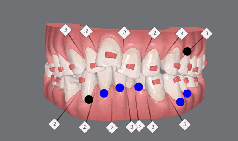 평생 삐뚤어진 치아가 고민이셨던 79세 고령환자분이 선택한 송파인비절라인다이아몬드등급 후기 (서울인비절라인전문치과 잠실인비절라인교정치과 노인교정 노인치아교정 노인교정치과) 관련 이미지 8