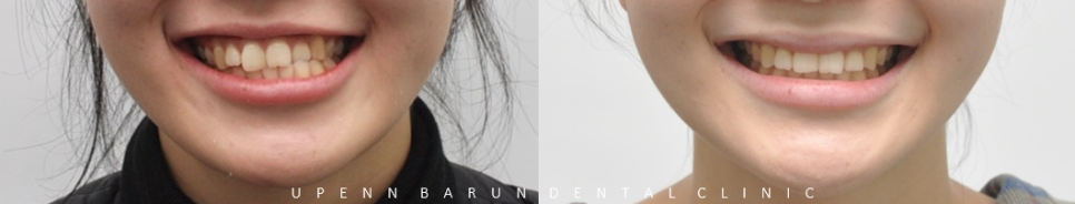 안면비대칭, 잠실수술교정, 잠실양악수술도 유펜바른치과입니다. 관련 이미지 5