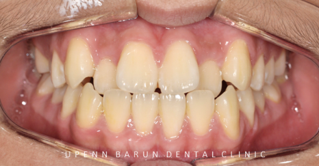 비발치교정 성장기교정 청소년치아교정은 잠실교정치과 유펜바른치과에서 관련 이미지 4