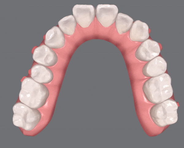 전세계 1400만명이 선택한 교정장치, 인비절라인 관련 이미지 4