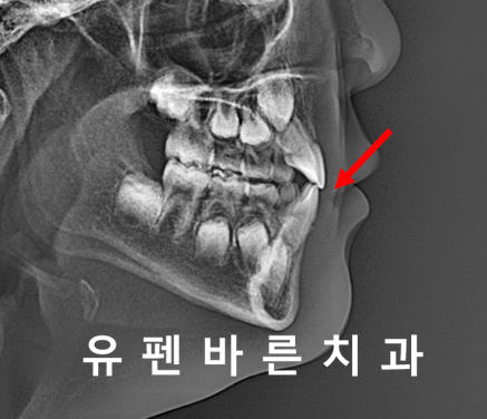 아이가 반대교합(주걱턱)인데 1차교정을 꼭해야 하나요? 관련 이미지 10