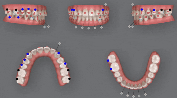 주걱턱 반대교합도 잠실인비절라인 잠실교정치과 유펜바른치과에서!(비발치주걱턱교정 잠실성인교정 반대교합인비절라인 잠실교정치과 주걱턱교정후기) 관련 이미지 15