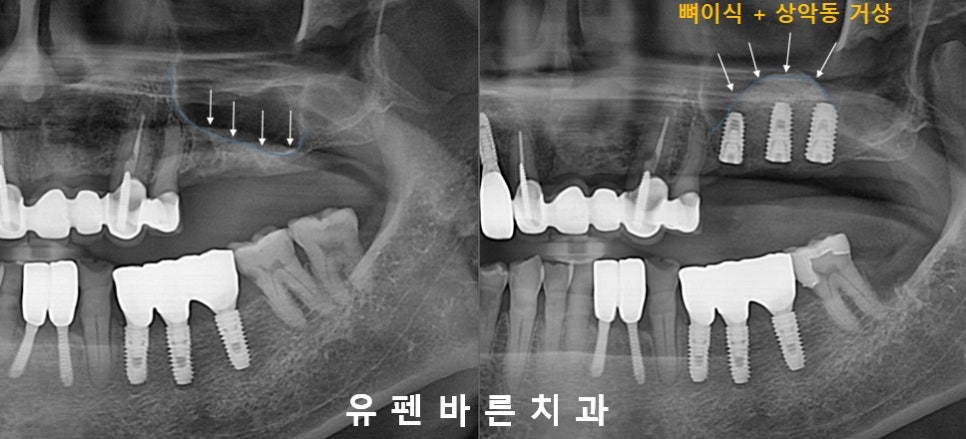 상악동 때문에 대학병원가서 임플란트 하라고 권유받으신 분들 필독!!! 관련 이미지 4