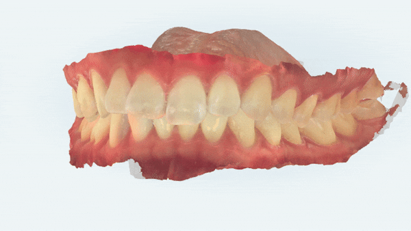 앞니부분교정 인비절라인라이트로 해결하기 (잠실인비절라인치과 송파인비절라인치과 잠실새내인비절라인치과 강동인비절라인치과 헬리오시티인비절라인 송파역인비절라인 석촌역인비절라인) 관련 이미지 2