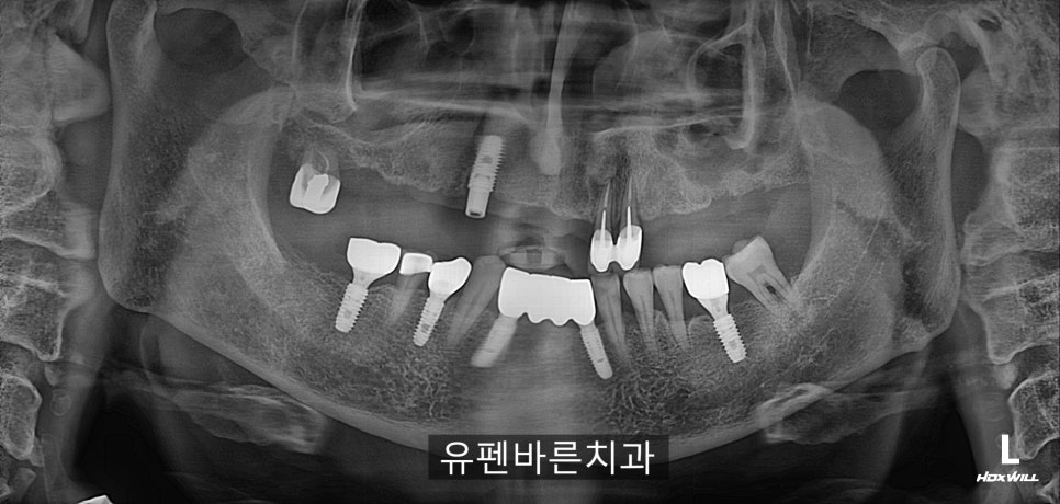해보니까 임플란트가 편해요!!! 관련 이미지 1