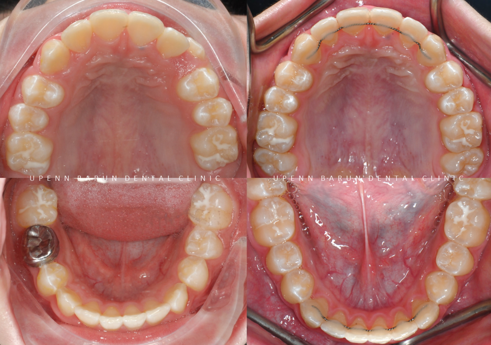 잠실소아인비절라인 잠실어린이인비절라인 송파인비절라인 잠실인비절라인후기 (잠실새내교정치과 엘스상가교정치과 파인애플상가교정치과 잠실새내역인비절라인 청소년교정후기 잠실인비절라인퍼스트) 관련 이미지 20