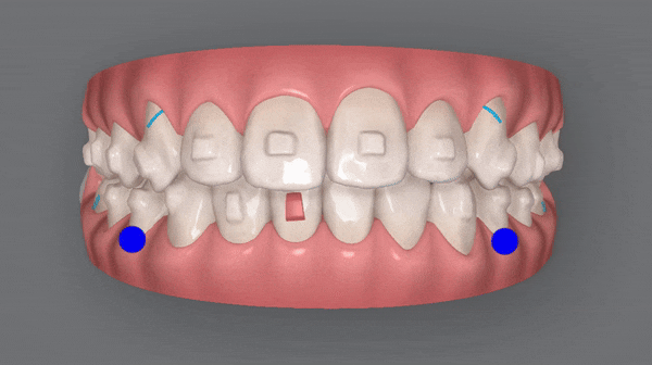 잠실소아인비절라인 잠실어린이인비절라인 송파인비절라인 잠실인비절라인후기 (잠실새내교정치과 엘스상가교정치과 파인애플상가교정치과 잠실새내역인비절라인 청소년교정후기 잠실인비절라인퍼스트) 관련 이미지 16