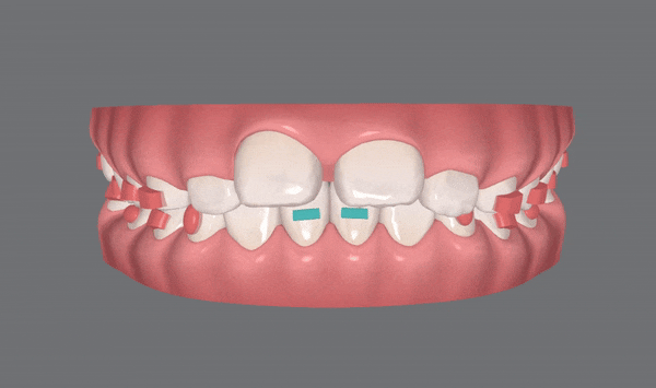 저도 친구들이 많이 하는 인비절라인교정 하고싶어요! 관련 이미지 6
