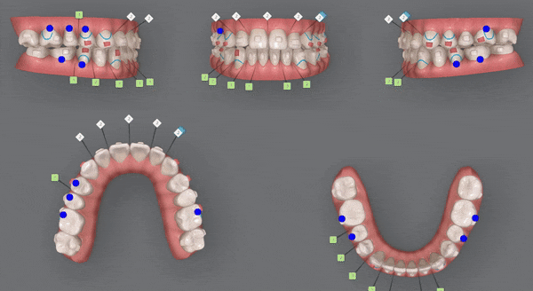 주걱턱 반대교합도 잠실인비절라인 잠실교정치과 유펜바른치과에서!(비발치주걱턱교정 잠실성인교정 반대교합인비절라인 잠실교정치과 주걱턱교정후기) 관련 이미지 20