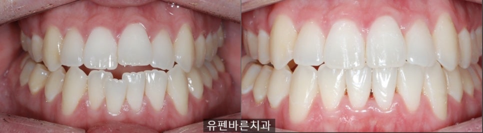 앞니끼리 맞물리지 않는데 인비절라인으로 교정 가능한가요? 관련 이미지 6