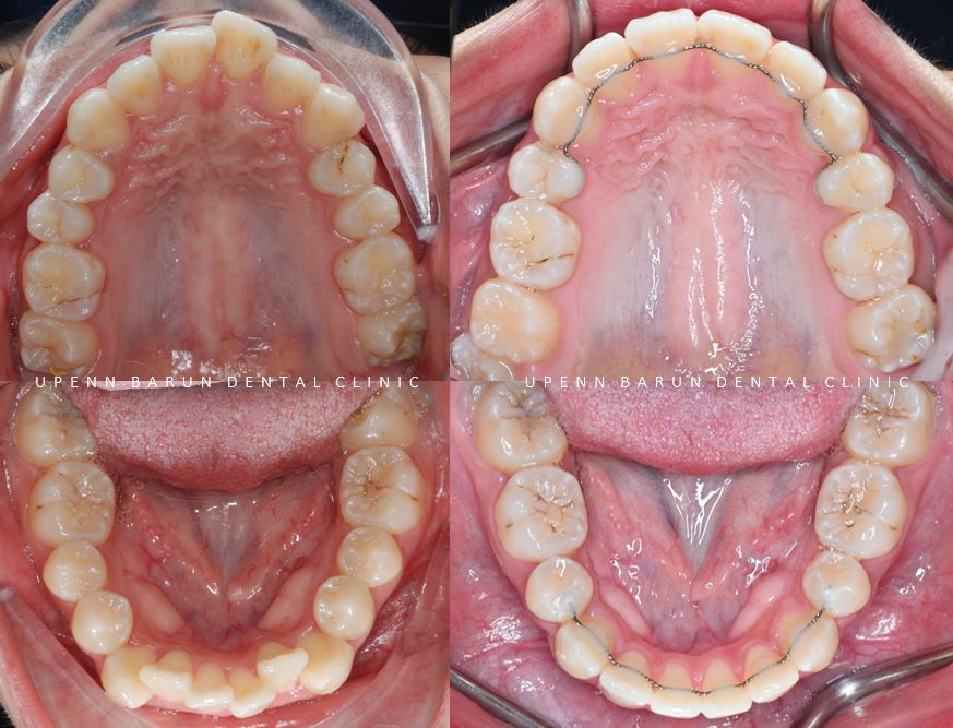 잠실돌출입교정 잠실발치교정 후기가 궁금하다면? (교정후얼굴변화후기 잠실교정치과 돌출입교정후기 돌출입전후사진) 관련 이미지 11
