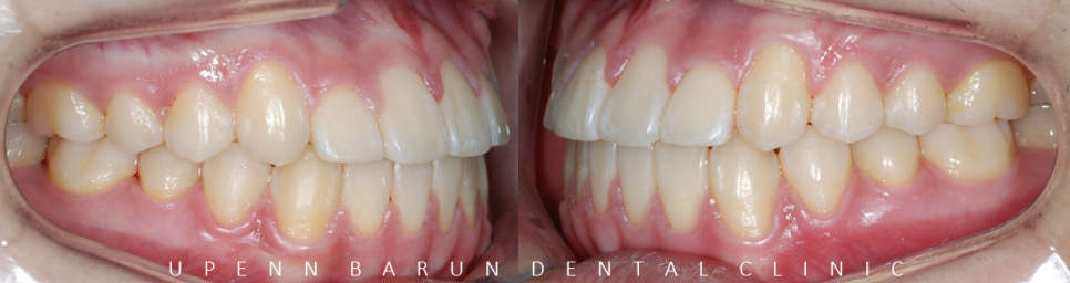 비발치교정 성장기교정 청소년치아교정은 잠실교정치과 유펜바른치과에서 관련 이미지 10
