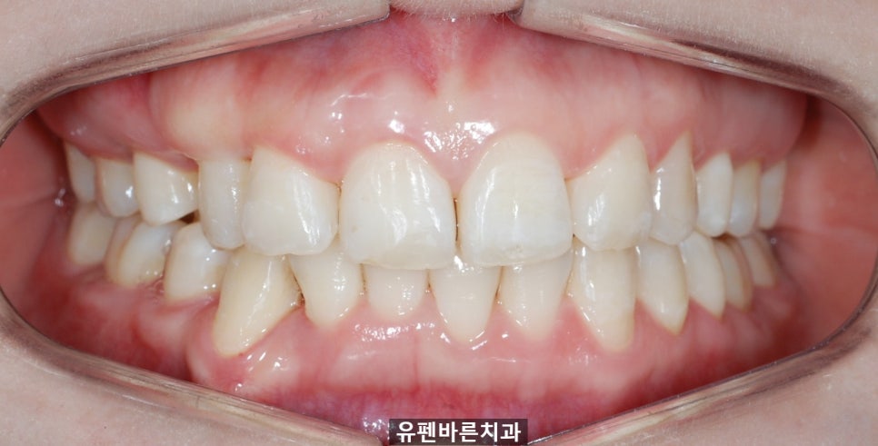 해외거주 중인데 발치교정도 인비절라인으로 가능한가요? 관련 이미지 13