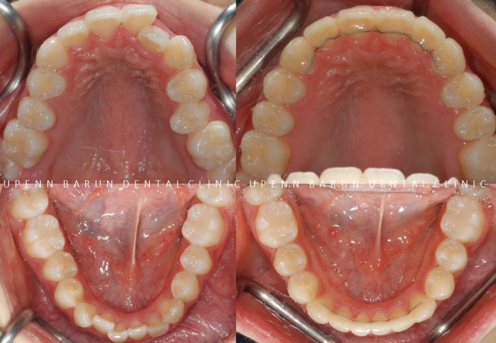 '웃을때 입을 자꾸 가려요'  활짝 웃은 중학생 비발치 인비절라인후기 (잠실새내인비절라인 청소년인비절라인 잠실교정치과) 관련 이미지 13