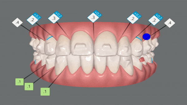 개방교합은 교정용 미니스크류 쓰지말고 인비절라인만으로 쉽게 해결하세요! (잠실인비절라인  잠실새내인비절라인  개방교합교정  잠실새내교정치과) 관련 이미지 12