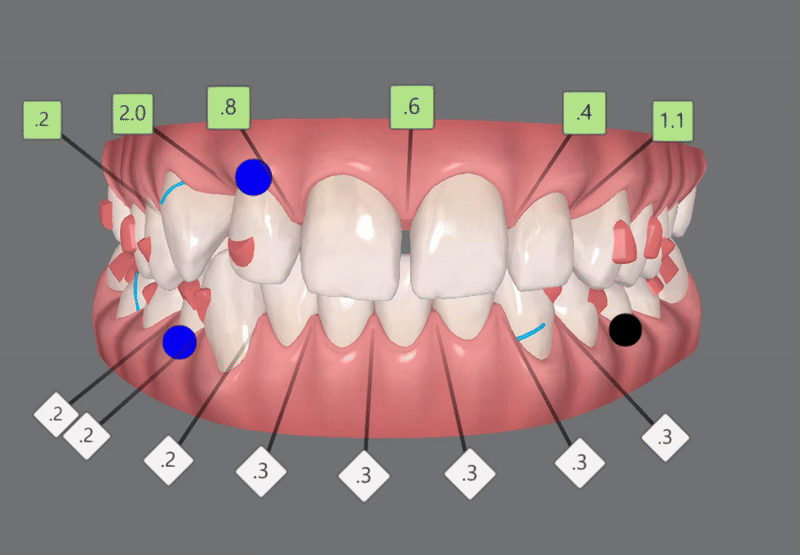 '옥니같이 보여요' 인비절라인급속교정 가능할까? with 캐리에모션장치 (잠실다이아몬드등급 인비절라인다이아몬드등급 서울다이아몬드등급치과 옥니인비절라인후기) 관련 이미지 8