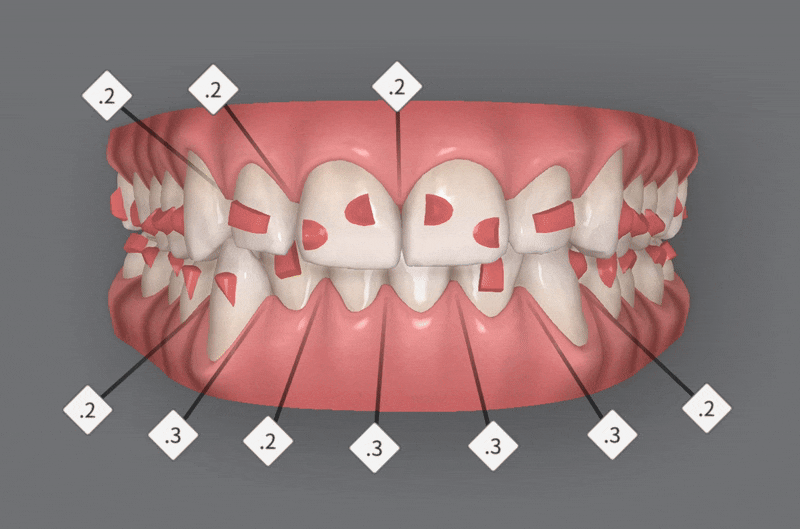 인비절라인다이아몬드등급치과에서 28개의 교정장치로 고민 해결한 후기가 궁금하다면? (잠실송곳니덧니교정 잠실인비절라인 인비절라인교정기간 투명교정장치후기 잠실인비절라인후기) 관련 이미지 5