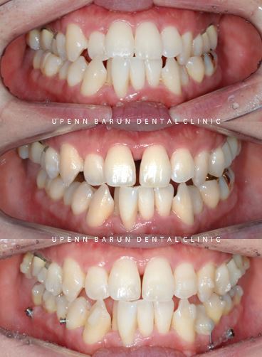 ABO 미국 치과교정과 전문의의 비수술치아교정 악궁확장장치 후기 (잠실교정전후 잠실새내교정치과 잠실교정치과 교정통증  앞니 변화) 관련 이미지 6