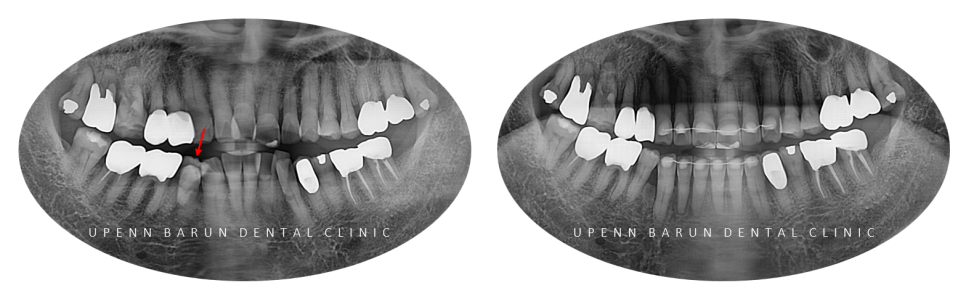 평생 삐뚤어진 치아가 고민이셨던 79세 고령환자분이 선택한 송파인비절라인다이아몬드등급 후기 (서울인비절라인전문치과 잠실인비절라인교정치과 노인교정 노인치아교정 노인교정치과) 관련 이미지 5