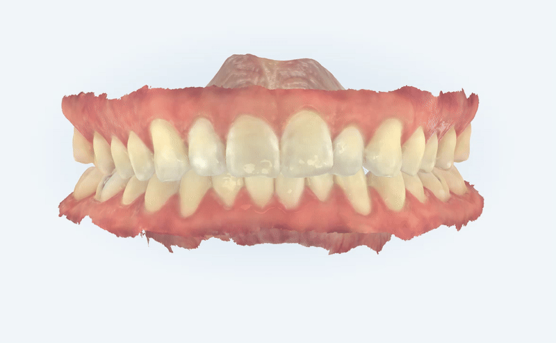인비절라인을 시작할때 고려해야 하는 세가지 조건 (인비절라인다이아몬드 다이아몬드등급치과 인비절라인앞니교정 앞니급속교정 비발치교정 치간삭제 치간삭제양) 관련 이미지 4