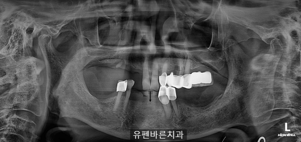 연세가 엄청 많으신데도 전체 임플란트 수술이 가능하다구요? 관련 이미지 1