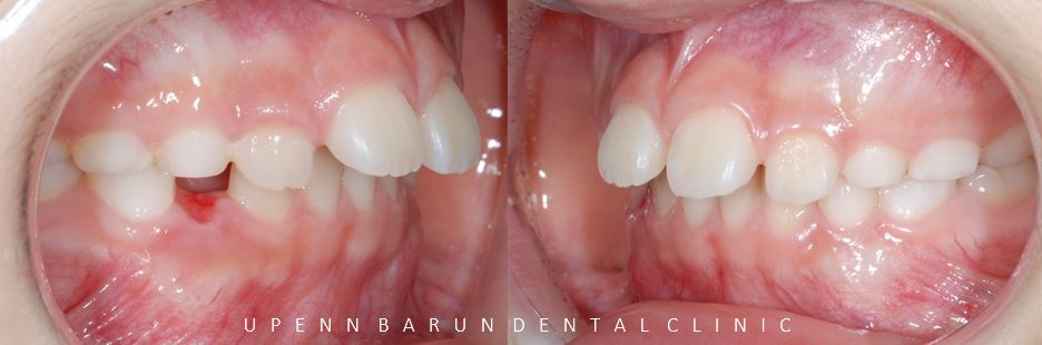 유독 튀어나와 다치기 쉬운 앞니! INVISALIGN FIRST로 8개월만에 끝낸 후기 (송파인비절라인소아교정 인비절라인1차교정 송파인비절라인퍼스트  송파인비절라인어린이교정) 관련 이미지 6
