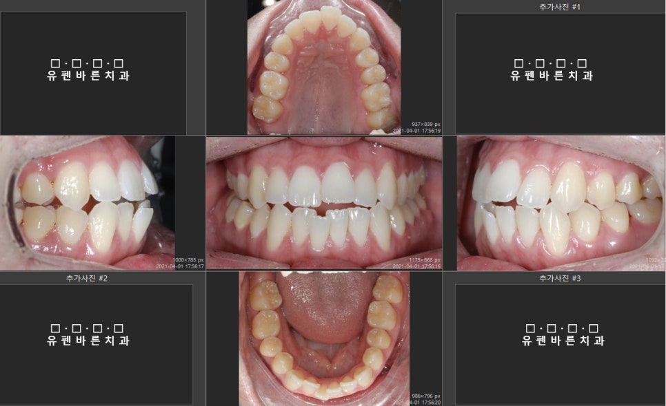 앞니끼리 맞물리지 않는데 인비절라인으로 교정 가능한가요? 관련 이미지 2