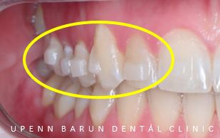 잠실인비절라인등급 잠실부분교정 앞니틈교정 인비절라인라이트 옵션으로 빠르게 해결한 후기 (삼성역부분교정 인비절라인앞니재교정 잠실역교정치과 삼전동인비절라인 삼전동교정치과) 관련 이미지 14