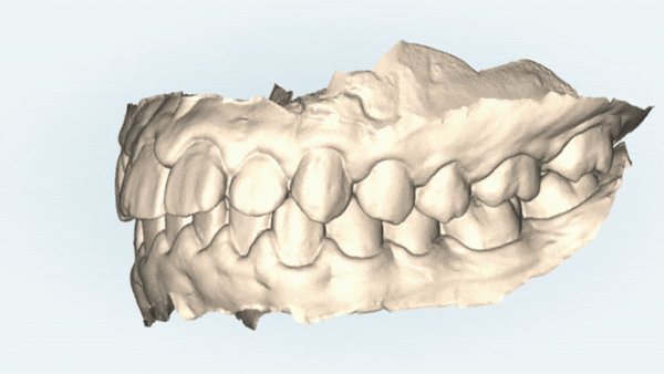 잠실청소년교정 청소년소년돌출입교정 잠실발치교정은 유펜바른치과에서! (잠실나루역교정치과 삼전역교정치과 잠실새내교정치과 돌출입전후 발치교정전후사진) 관련 이미지 6