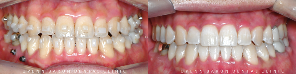 주걱턱 반대교합도 잠실인비절라인 잠실교정치과 유펜바른치과에서!(비발치주걱턱교정 잠실성인교정 반대교합인비절라인 잠실교정치과 주걱턱교정후기) 관련 이미지 21
