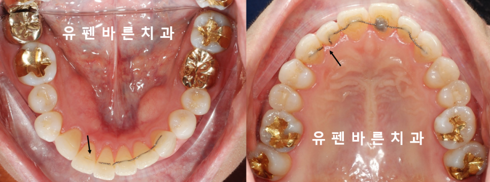 인비절라인으로 재교정, 가능할까용?? 관련 이미지 3