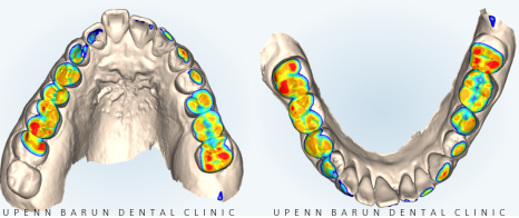 인비절라인 공식 스피커가 상주하고 치료하는 송파교정잘하는치과 유펜바른치과 (잠실성인교정 잠실재교정 잠실인비절라인 성인인비절라인교정 잠실나루역교정치과 문정동교정치과 삼전역교정치과) 관련 이미지 5