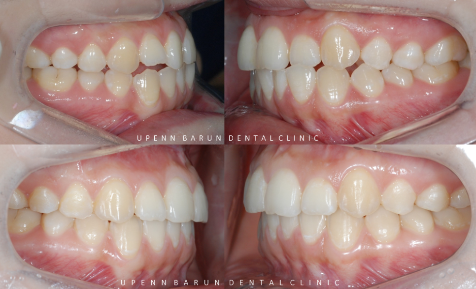 안면비대칭, 잠실수술교정, 잠실양악수술도 유펜바른치과입니다. 관련 이미지 8