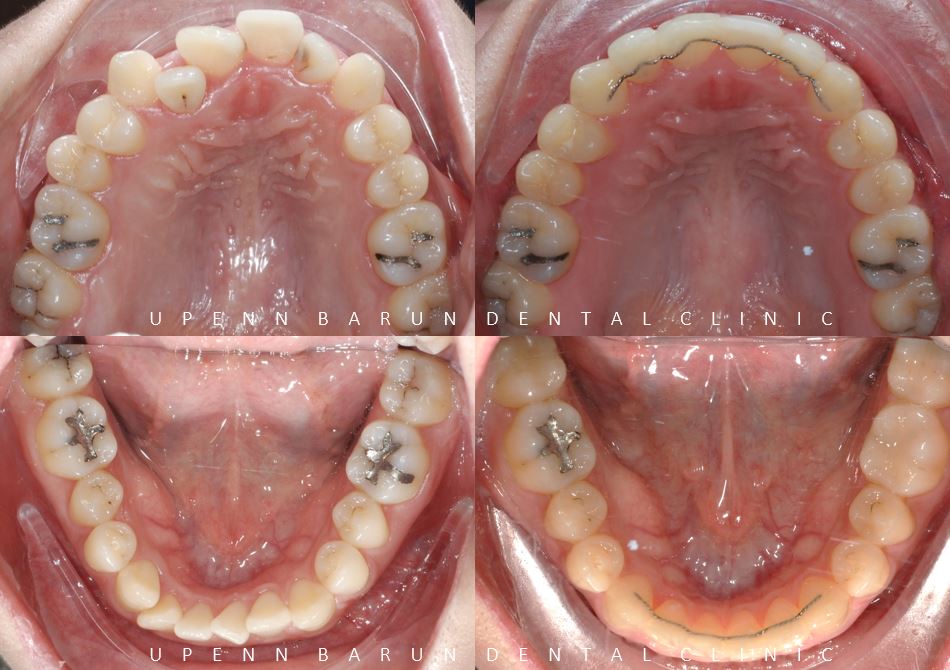 잠실데이몬교정, 비발치교정, 잠실덧니교정 (AKA Damon Smile) 관련 이미지 9