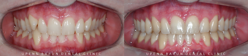 '옥니같이 보여요' 인비절라인급속교정 가능할까? with 캐리에모션장치 (잠실다이아몬드등급 인비절라인다이아몬드등급 서울다이아몬드등급치과 옥니인비절라인후기) 관련 이미지 16