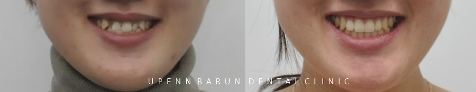 잠실데이몬교정, 비발치교정, 잠실덧니교정 (AKA Damon Smile) 관련 이미지 11