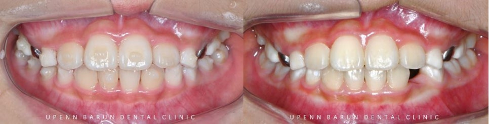 8세 어린이반대교합 인비절라인퍼스트로 수월하게 해결 후기! 잠실인비절라인퍼스트 잠실인비절라인소아교정 (잠실교정치과 잠실인비절라인 인비절라인등급 인비절라인후기 잠실소아교정) 관련 이미지 14