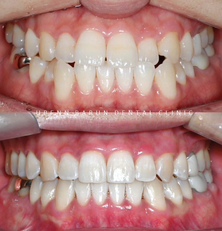 주걱턱 반대교합도 잠실인비절라인 잠실교정치과 유펜바른치과에서!(비발치주걱턱교정 잠실성인교정 반대교합인비절라인 잠실교정치과 주걱턱교정후기) 관련 이미지 8
