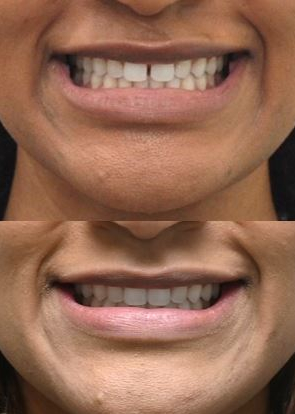 앞니벌어짐 인비절라인익스프레스로 해결하기 (인비절라인앞니부분교정 인비절라인재교정 송파인비절라인 잠실인비절라인 잠실교정치과 인비절라인익스프레스비용) 관련 이미지 4