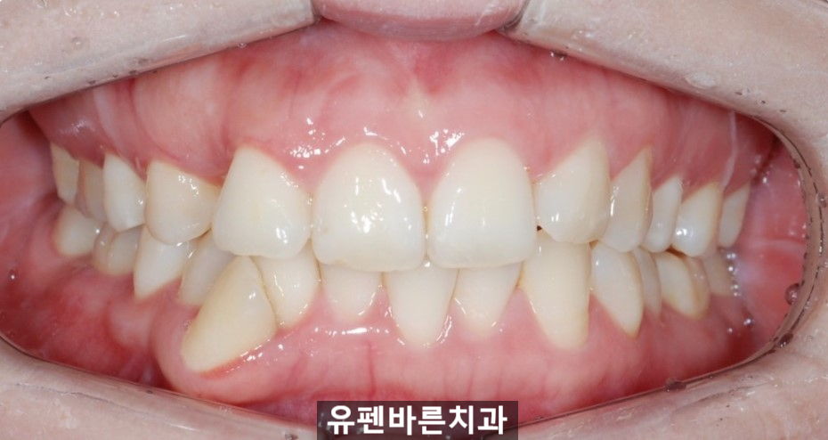 해외거주 중인데 발치교정도 인비절라인으로 가능한가요? 관련 이미지 12