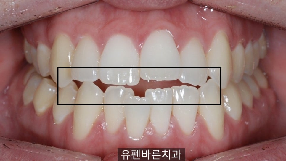 앞니끼리 맞물리지 않는데 인비절라인으로 교정 가능한가요? 관련 이미지 3