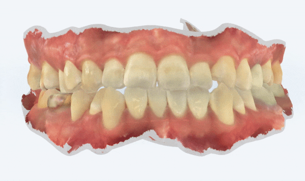 인비절라인 제작과정, 제작까지 소요시간, 어떻게 만들어지는지 궁금하다면?  (치아교정 l 투명교정 l 인비절라인) 관련 이미지 4