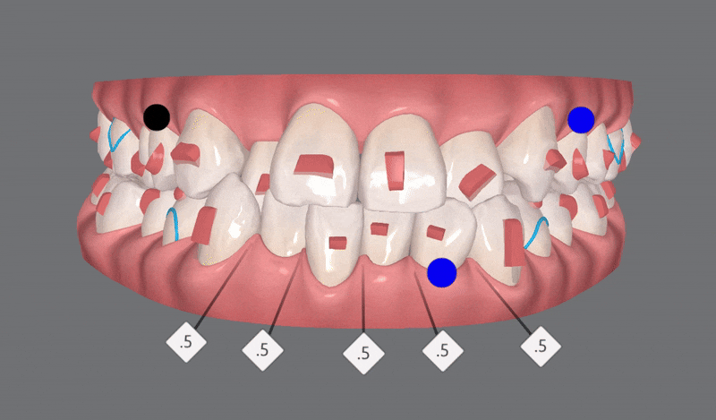 송파인비절라인다이아몬드등급 치과에서 악궁확장장치 없이 반대교합 해결한 후기(인비절라인높은등급 인비절라인반대교합 인비절라인비발치교정 인비절라인잘하는치과 인비절라인교정전문) 관련 이미지 7