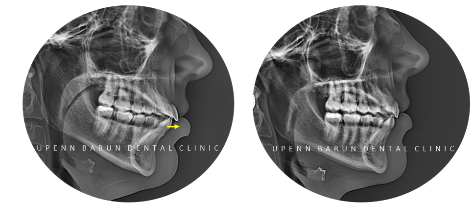 "치아가 앞으로 뻐드러졌어요!" 송파인비절라인다이아몬드등급치과에서!!(비발치인비절라인 뻐드렁니교정치과 돌출입교정치과) 관련 이미지 16