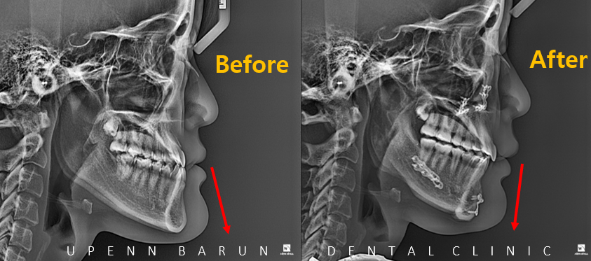 주걱턱교정, 수술교정, 양악수술도 잠실교정치과 유펜바른치과에서 관련 이미지 8