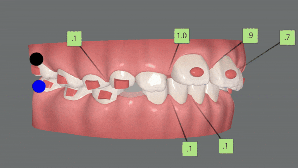 유독 튀어나와 다치기 쉬운 앞니! INVISALIGN FIRST로 8개월만에 끝낸 후기 (송파인비절라인소아교정 인비절라인1차교정 송파인비절라인퍼스트  송파인비절라인어린이교정) 관련 이미지 8
