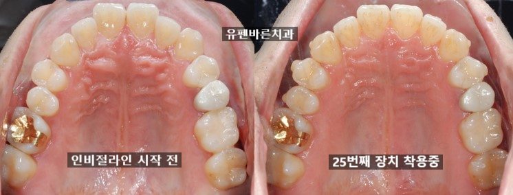 치과위생사의 인비절라인 두번째 이야기 관련 이미지 4