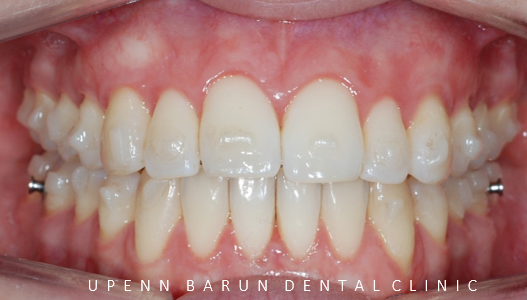 개방교합은 교정용 미니스크류 쓰지말고 인비절라인만으로 쉽게 해결하세요! (잠실인비절라인  잠실새내인비절라인  개방교합교정  잠실새내교정치과) 관련 이미지 11